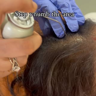 GFC PRP @dr.shalusavla_gala 

#drshalusavla_gala #gfcprphairtreatment #hairlosstreatment #nonsurgica