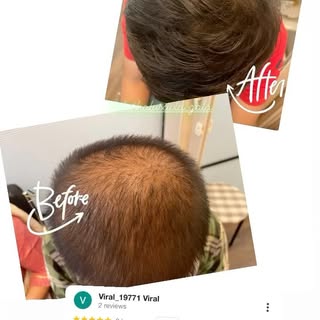 Androgenetic Alopecia Before & After @dr.shalusavla_gala 

#hairlosssolution #prptreatment #minoxidi
