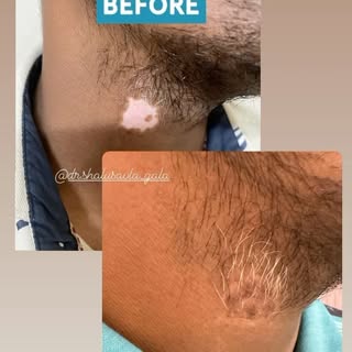 VITILIGO SURGERY 
MINI PUNCH GRAFT SURGERY BEFORE & AFTER 

#drshalusavla_gala #vitiligosurgery #bef