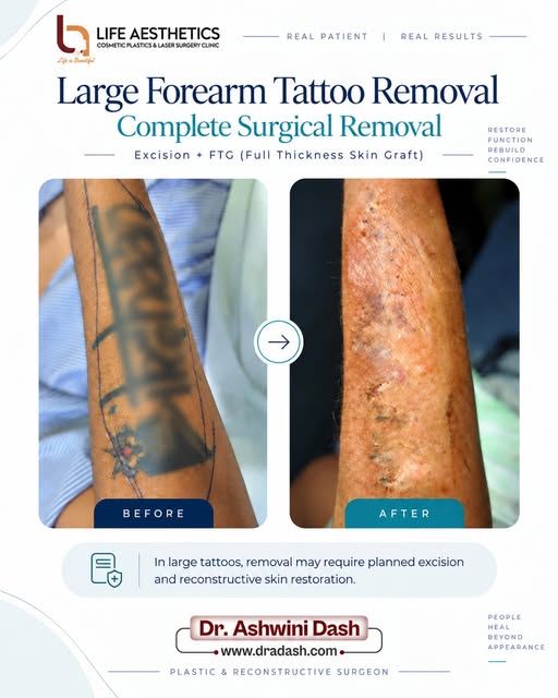 Looking to get rid of a large forearm tattoo that hasn't responded well to traditional methods? 🤔 W