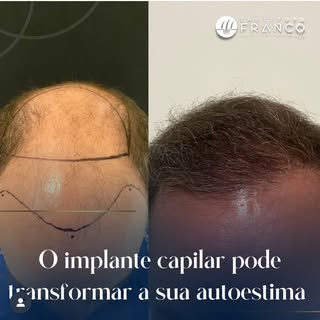 O implante capilar pode transformar sua autoestima! ✨

👉🏻 No Instituro Franco você encontra profis