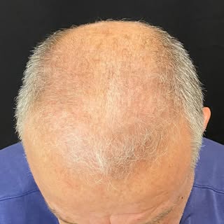 Para quem acha que Transplante Capilar  não muda nada , ou não é uma cirurgia que rejuvenesce! Acred