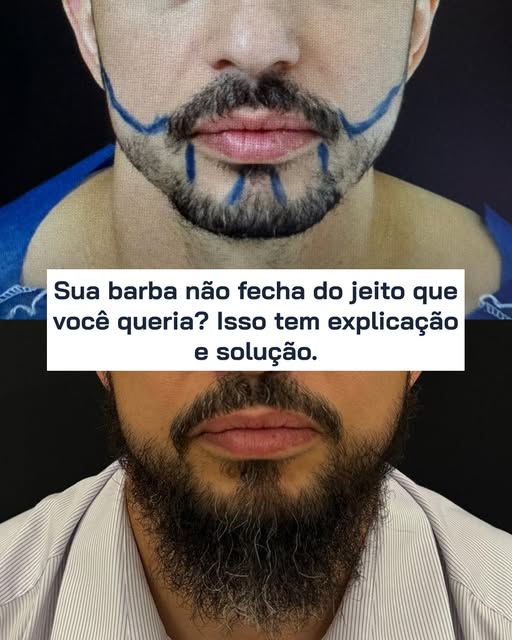 Você também sente isso? Aquela vontade de deixar a barba cheia, mas ela simplesmente não fecha em al