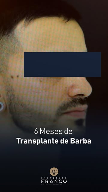 Barba rala, falhada ou desigual? 

6 meses atrás essa era a realidade de mais um paciente do Institu
