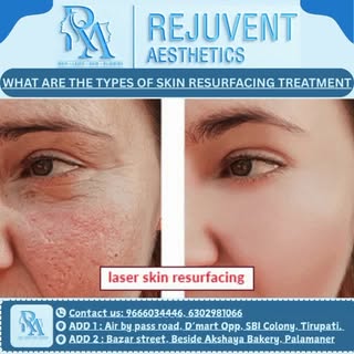 Types of Skin Resurfacing Treatment............... Rejuvent Aesthetics 
.
.
.
.
.
.
.
.
.
Contact us