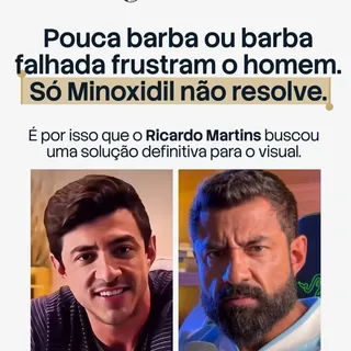 A calvície e as falhas na barba costumam vir acompanhadas de promessas milagrosas: shampoos, fórmula