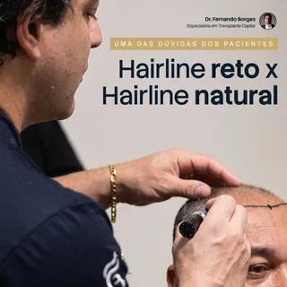 Um hairline reto demais é o primeiro sinal de um transplante malfeito.

O cabelo natural nunca nasce