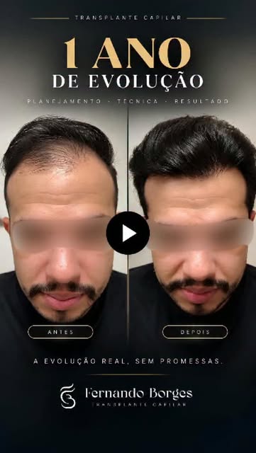 Cada transplante capilar é resultado de um planejamento individualizado.

Neste caso, apresentamos a