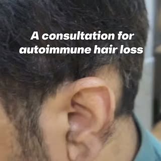 If your alopecia areata keeps coming back, treating the patch alone may not be enough.

Alopecia are