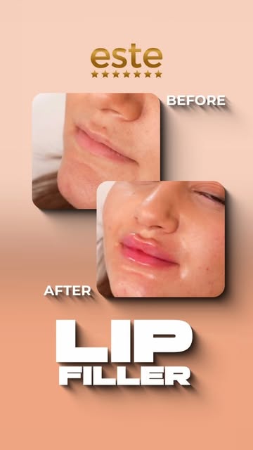 ✨ Soft Volume. Perfect Shape. Natural Confidence. ✨
Este Lip Filler

Thin lips, uneven shape বা volu
