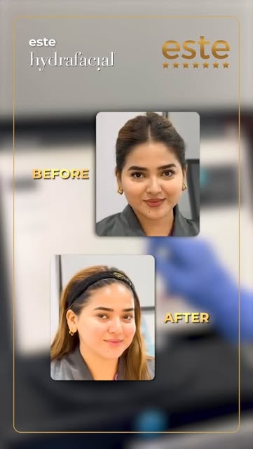 ✨ Instant Glow. Deep Clean. Total Skin Refresh. ✨
Hydrafacial Treatment at Este

Dull skin, clogged 