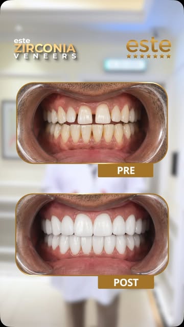 ✨Perfect Smile, Natural Beauty & Lasting Confidence with Este Zirconia Veneers✨

আপনার smile-এর প্রয়