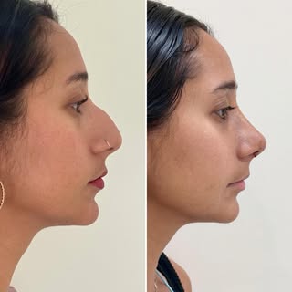Ha pasado 1 semana post rinoplastia ultrasónica, hemos retirado la escayola y estos son los resultad