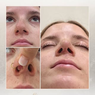 "No todas las narices deberían ser operadas por cualquier cirujano" 👃

Desliza para ver el antes y 