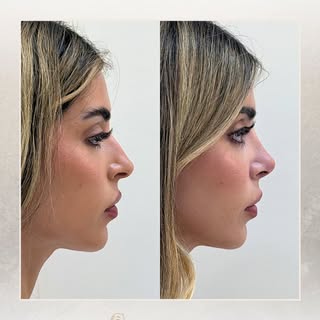 ¿Te has preguntado por qué, justo después de una rinoplastia ultrasónica, la punta puede verse un po