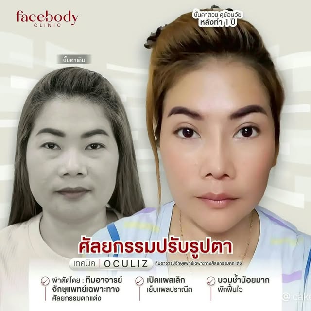 เพราะดวงตา 👁 คือ จุดเริ่มต้นของความอ่อนเยาว์
#ศัลยกรรมปรับรูปตา เทคนิค 🦋 𝙊𝙘𝙪𝙡𝙞𝙯 ( Oculoplast