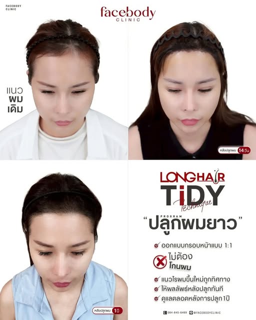 ปลูกผมเทคนิค #LongHairTiDY
✔ ไม่ต้องตัดผม ไม่ต้องโกนผม
✔ ผมยาวก็สามารถปลูกได้
✔ ไม่ต้องคาดผ้าที่แผลห
