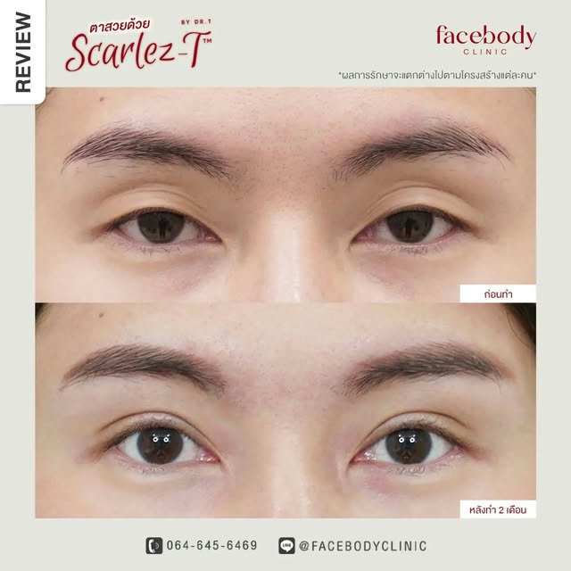 เพื่อความสวย 🩷 และความปลอดภัยของตนเอง #ศัลยกรรมรอบดวงตา 🩺 ควรเลือกทำกับศัลยแพทย์ตกแต่งเฉพาะทาง ที่