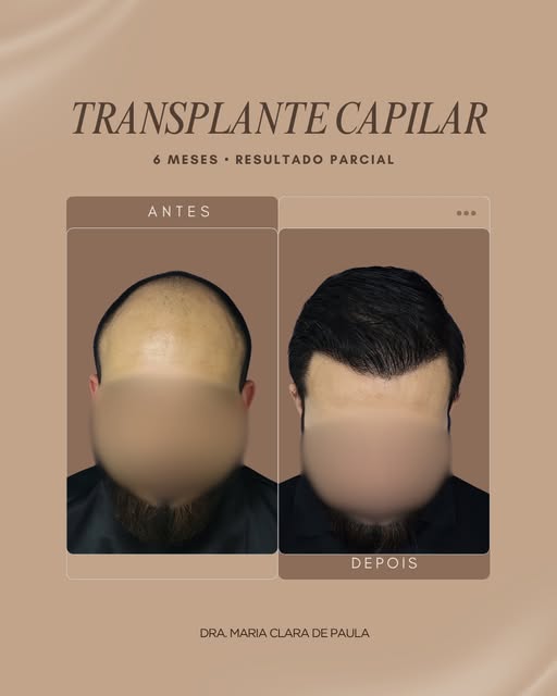 Mais que devolver cabelos, o transplante capilar resgata a autoconfiança e a segurança de se olhar n