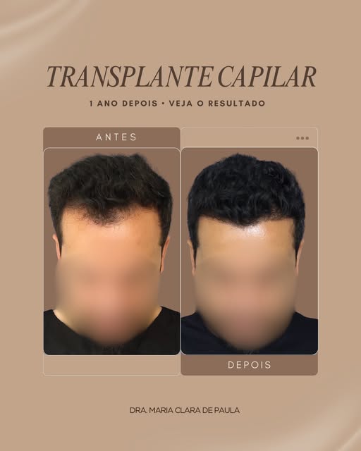 ✨ As entradas e a mudança no contorno do cabelo incomodam você?

Neste carrossel, compartilhamos o a