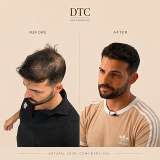 משיער דליל לשיער שופע.
אין כאן קסם.
יש כאן תכנון מדויק, מקצוענות וניסיון.