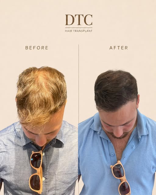 FROM THINNING TO THRIVING.

יותר כיסוי, יותר צפיפות
והכי חשוב,  מראה טבעי.