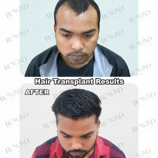 ✨ **8-Month Hair Transplant Result!** ✨

From visible hair loss to a fuller, more defined hairline —