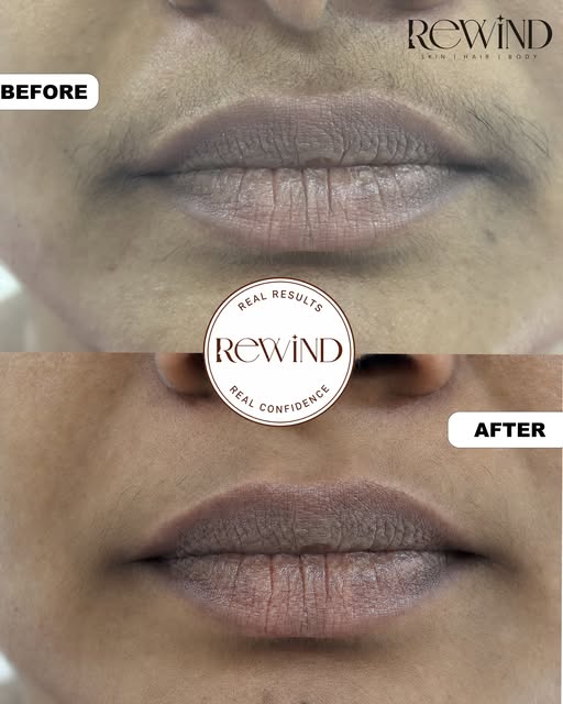 ✨ **LHR RESULTS | BEFORE & AFTER** ✨

Real results. Real confidence. 🤎

See the visible transformat