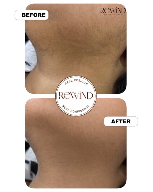 LHR (Laser Hair Reduction) – Real Results! 🤎✨

Visible hair reduction after 4 sessions at Rewind Ae