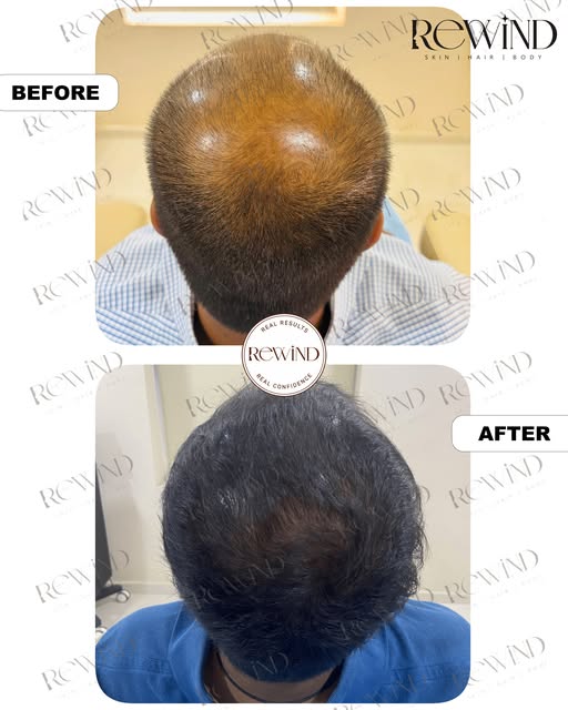 GFC + PDO THREADS | REAL RESULTS ✨

Hair thinning and reduced density can have different causes—and 