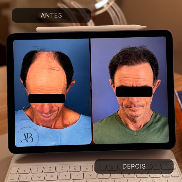 Um resultado que começa muito antes da cirurgia: no planejamento da área doadora.

Neste caso, a boa