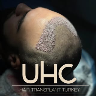ART OF THE HAIR TRANSPLANT WITH UNI HAIR CLINIC 
#hairtransplant#hairtransformation#hairtransplanttu