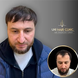 1 Year After Hair Transplant 
New life — new hair, new confidence! 
#hairtransplant #hairtransplantm