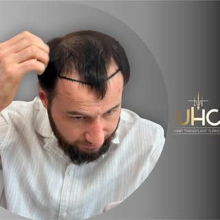 UNI HAIR CLINIC ALWAYS READY TO MAKE YOU HAPPY 
#hairtransformation#hairtransplant#haircut#