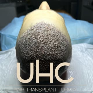 ART OF THE HAIR TRANSPLANT WITH UNI HAIR CLINIC 
#hairtransplant#hairtransformation#hairtransplanttu