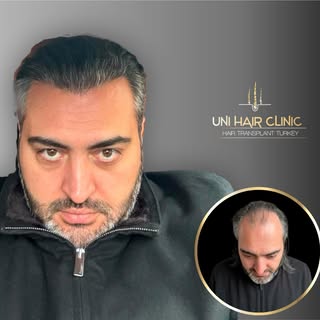 WE ARE PLEASED TO SHARE OUR DEAR PATIENT RESULT IN ONE YEAR OF THE HAIR TRANSPLANT 
YOU ALSO CAN GET