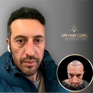 UNI HAIR CLINIC ALWAYS READY TO MAKE YOU HAPPY 
GET THE BEST HAIR TRANSPLANT EVER WITH UNI HAIR CLIN