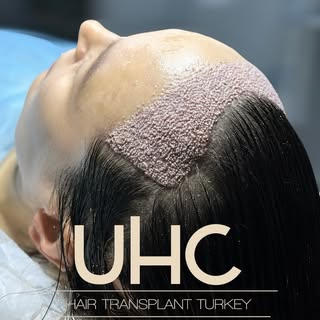WOMENS HAIR TRANSPLANT WITH UNI HAIR CLINIC