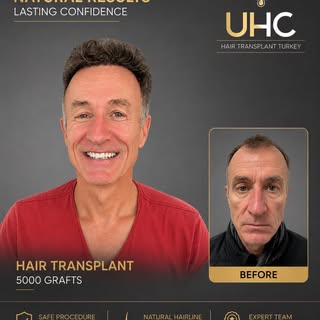 5000 GRAFTS HAIR TRANSPLANT RESULTS IN 1 year 
#hairtransplant#hairtransplantturkey#hairtransplantis
