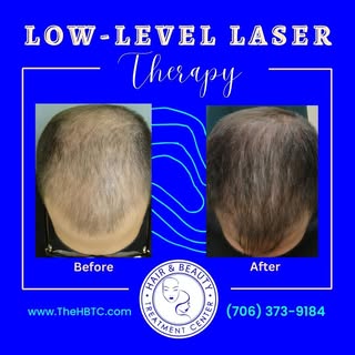 🎉 Ready to experience a hair transformation? Look no further! With HBTC's Low–Level Laser Therapy, 