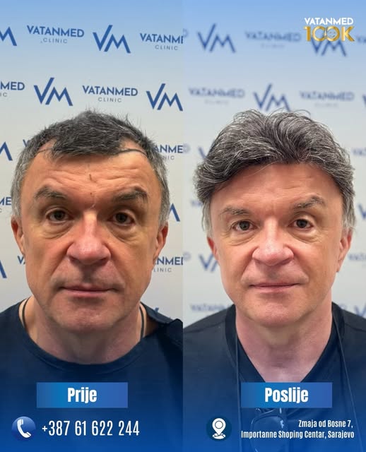 9 mjeseci nakon transplantacije!!!

Naš pacijent Zlatko danas je došao na kontrolu, a njegovo zadovo