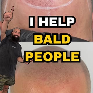 I HELP BALD PEOPLE.

Receding hairlines. Thinning hair. Hair-transplant scars. Regular scalp scars.
