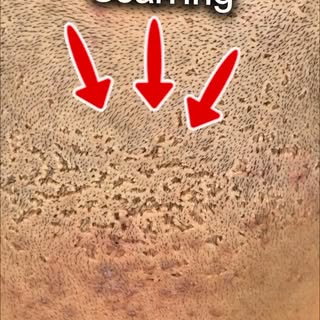 Extreme folliculitis scarring.

With scarring like this, SMP can’t remove the pits themselves, so th