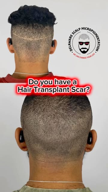 FUT hair transplant scar camouflage by Joey Dots at Delaware Scalp Micropigmentation.

This client p