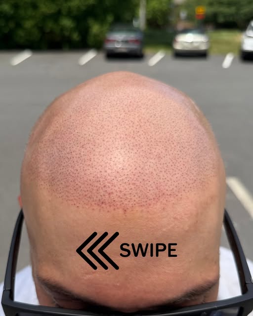 Immediately after the third session, the redness will subside within 24 to 48 hours. Super natural r