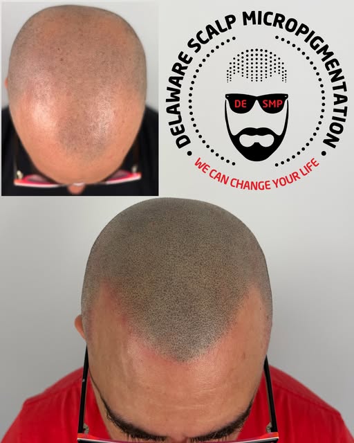 Incredible transformation 🔥 A super natural, age-appropriate hairline designed to restore confidenc