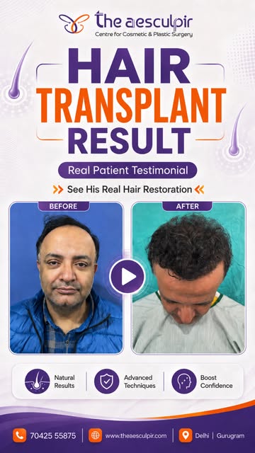 A real patient shares his experience after Hair Transplant Treatment at The Aesculpir Clinic. Hair t