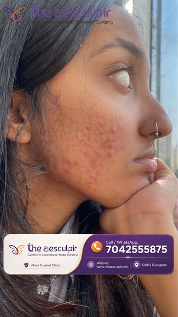 A real acne journey, shared by one of my patients. ✨

Acne is never just “a few pimples". For many p