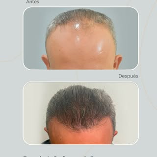 Trasplante Capilar en cabello canoso. 
Con una ejecución estratégica logramos una densidad homogénea