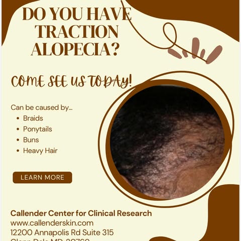 #TractionAlopecia is a form of hair loss caused by repeated or prolonged pulling (tension) on the ha